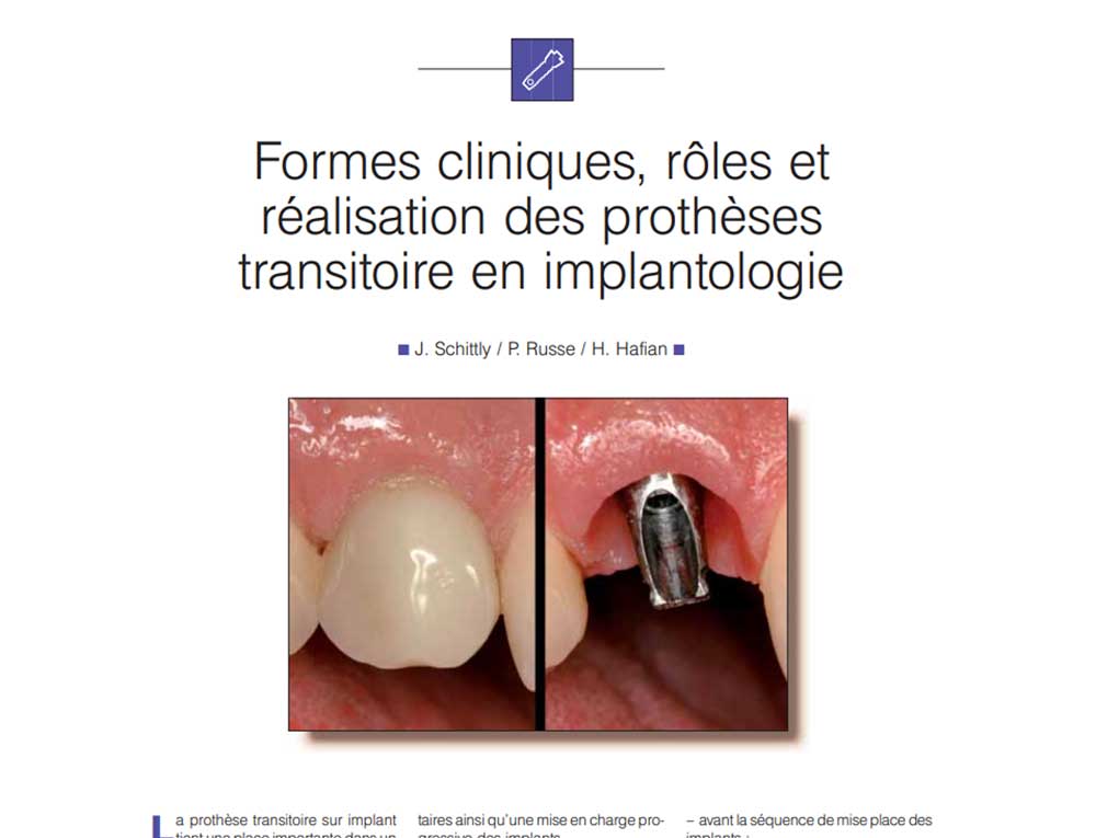 Protheses transitoires